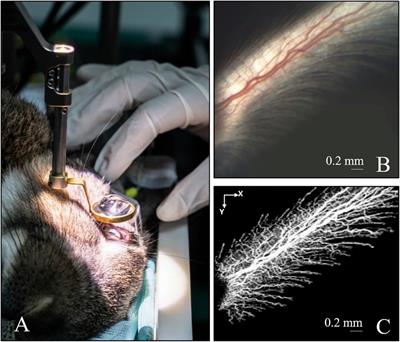 Intraoperative optical coherence tomography angiography for intraocular surgery